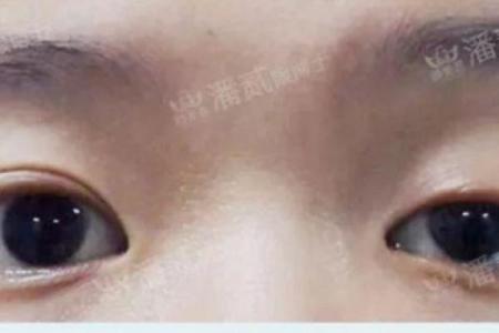 眼睛八字痕是什么 以及预防和缓解技巧