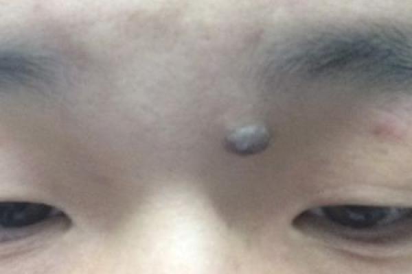 了解肉痣相：不同部位的肉痣暗示着什么
