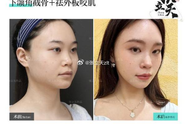 现代面相整形技术如何帮助塑造完美脸型