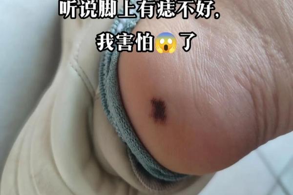 足痣位置解析：你脚上的痣暗示了什么人生轨迹