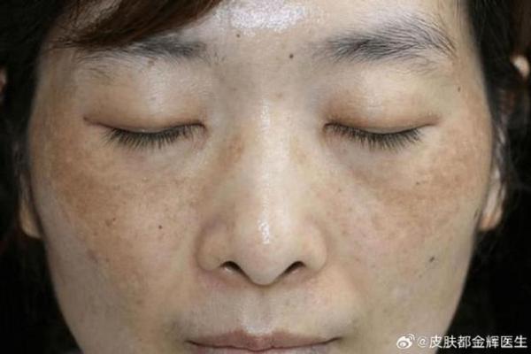 揭秘：雀斑与面相的秘密，影响命运还是纯粹美观问题？