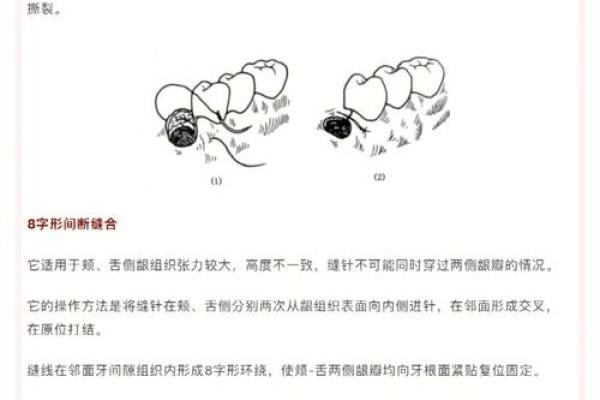 你不知道的八字缝合术，轻松学会迅速止血