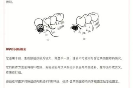 你不知道的八字缝合术，轻松学会迅速止血