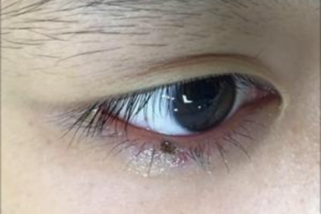 眼睑边痣，神秘诱惑力