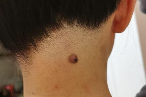 一颗痣改变命运，揭秘脖子痣的神奇力量