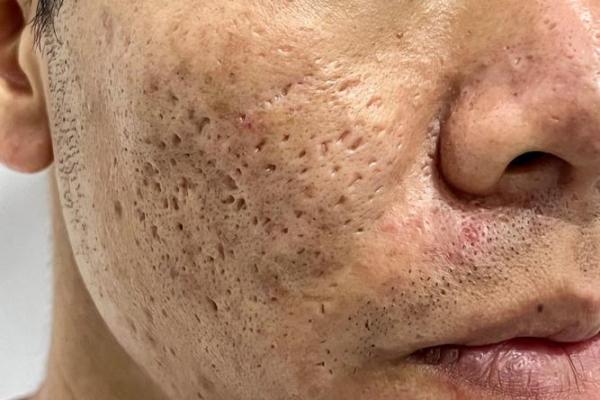 面相揭秘：痘坑多竟影响运势，你的面相还好吗？