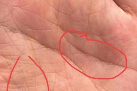 手相揭秘：太阴丘有痣竟预示着这样的命运